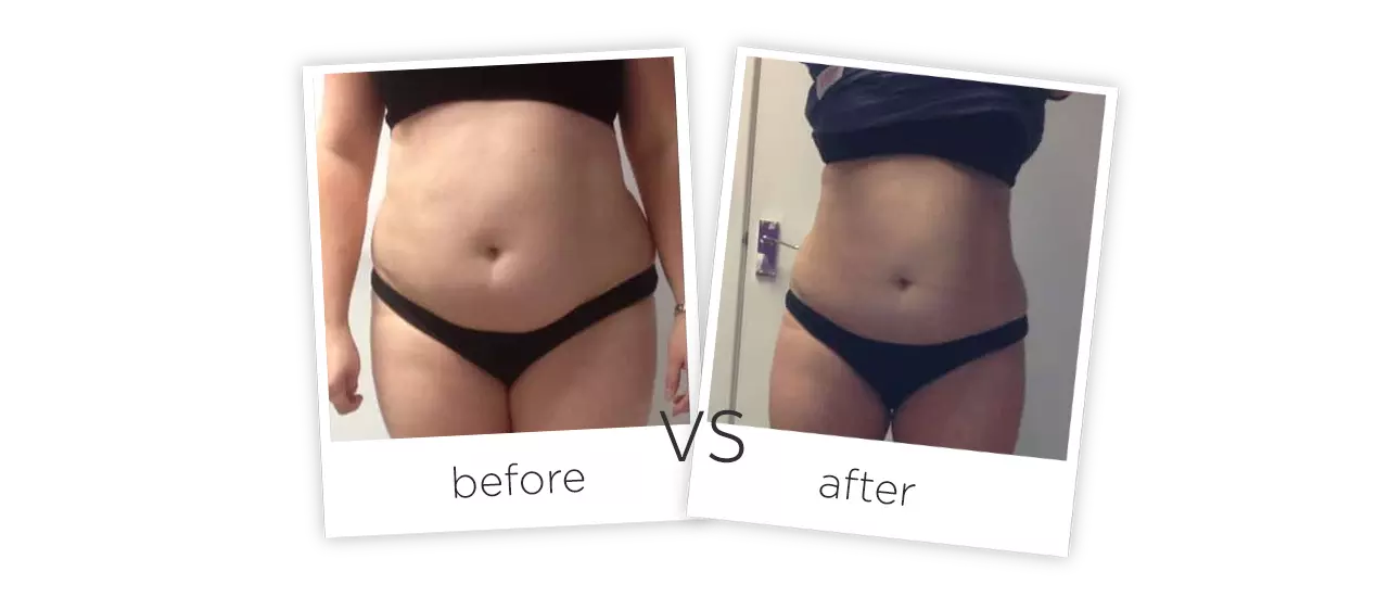 Cooling Cryolipolysis Machine Before&After