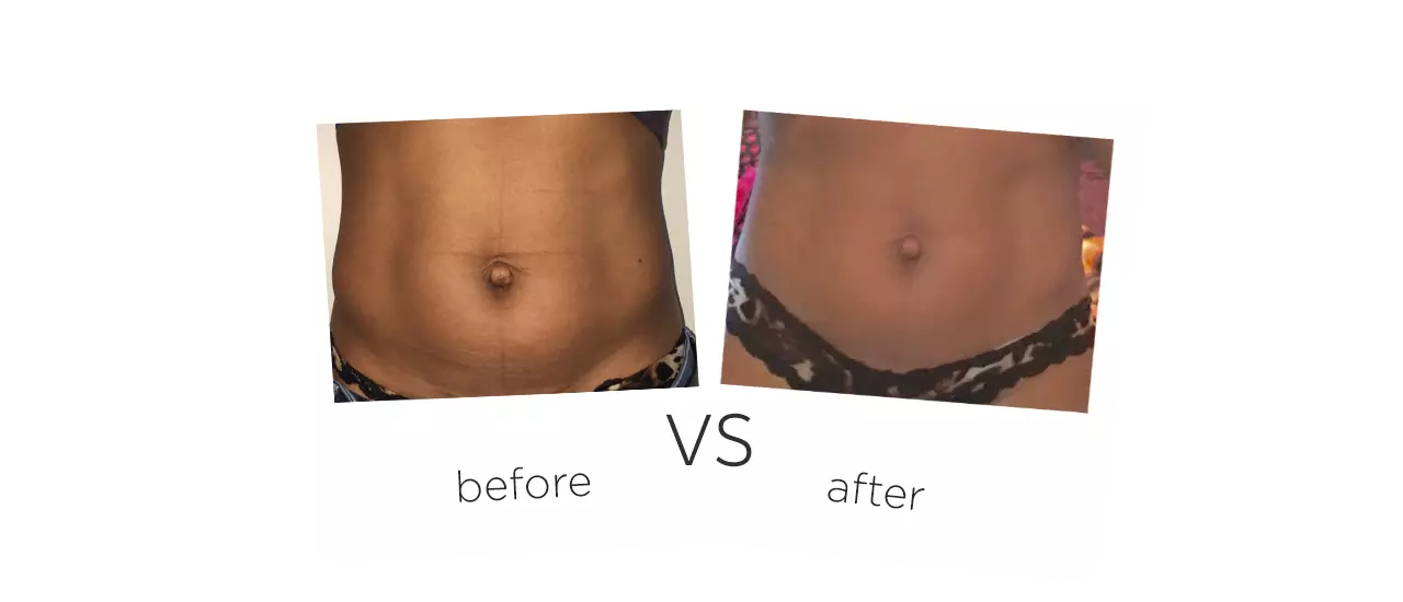 Cooling Cryolipolysis Machine Treatment Before&After
