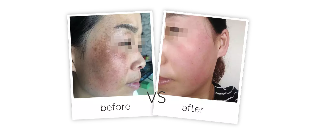 IPL Before&After
