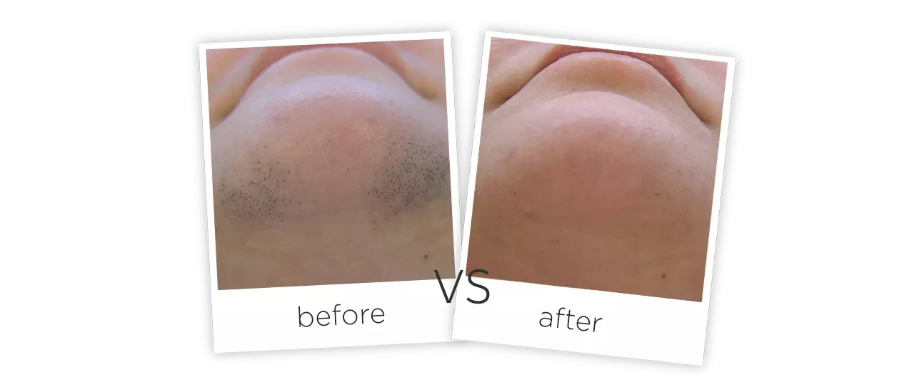 IPL Treatment Before&After