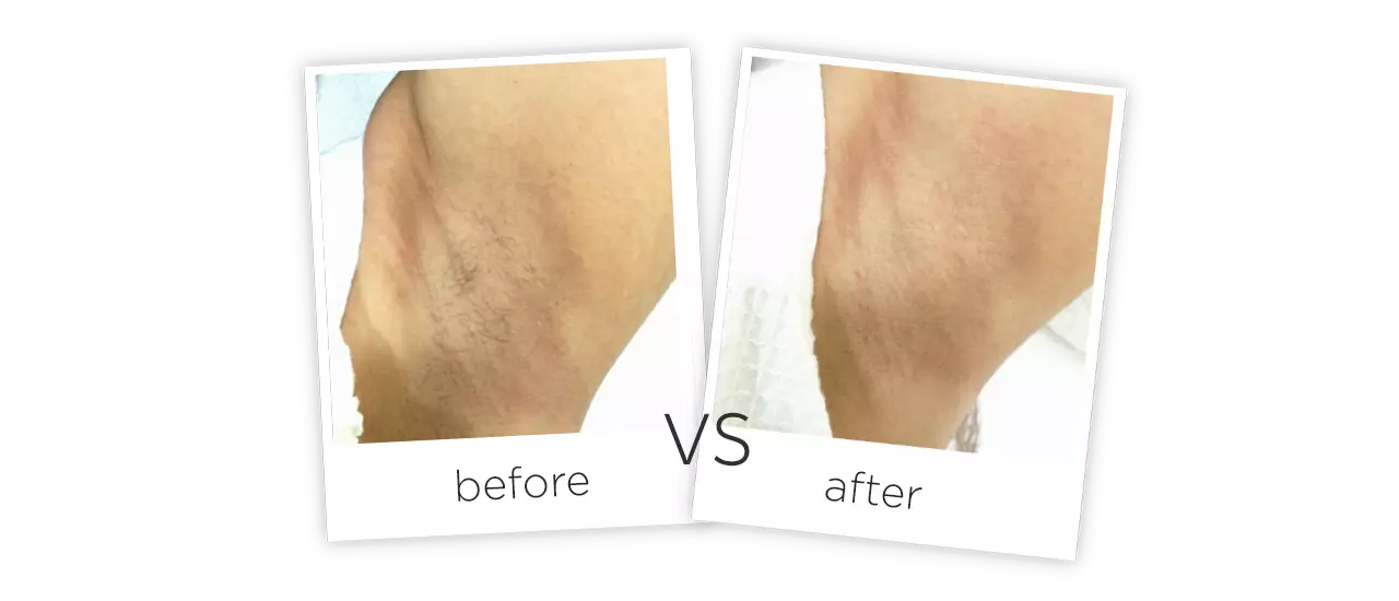 IPL Treatment Before&After