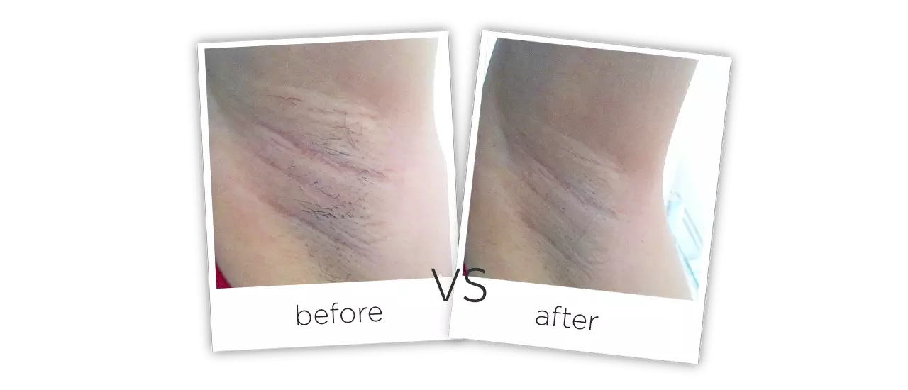 IPL Treatment Before&After