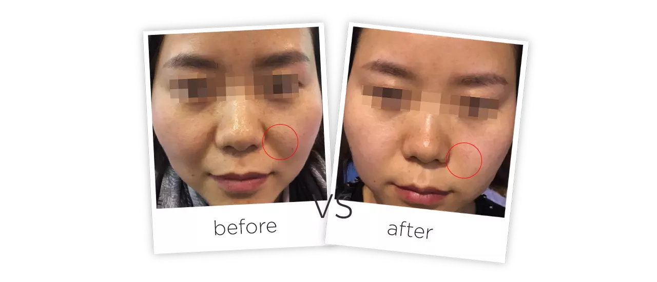 HIFU Before&After