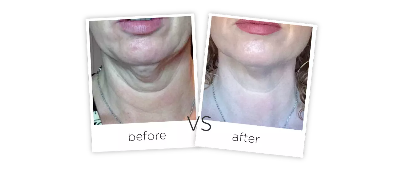 HIFU Treatment Before&After