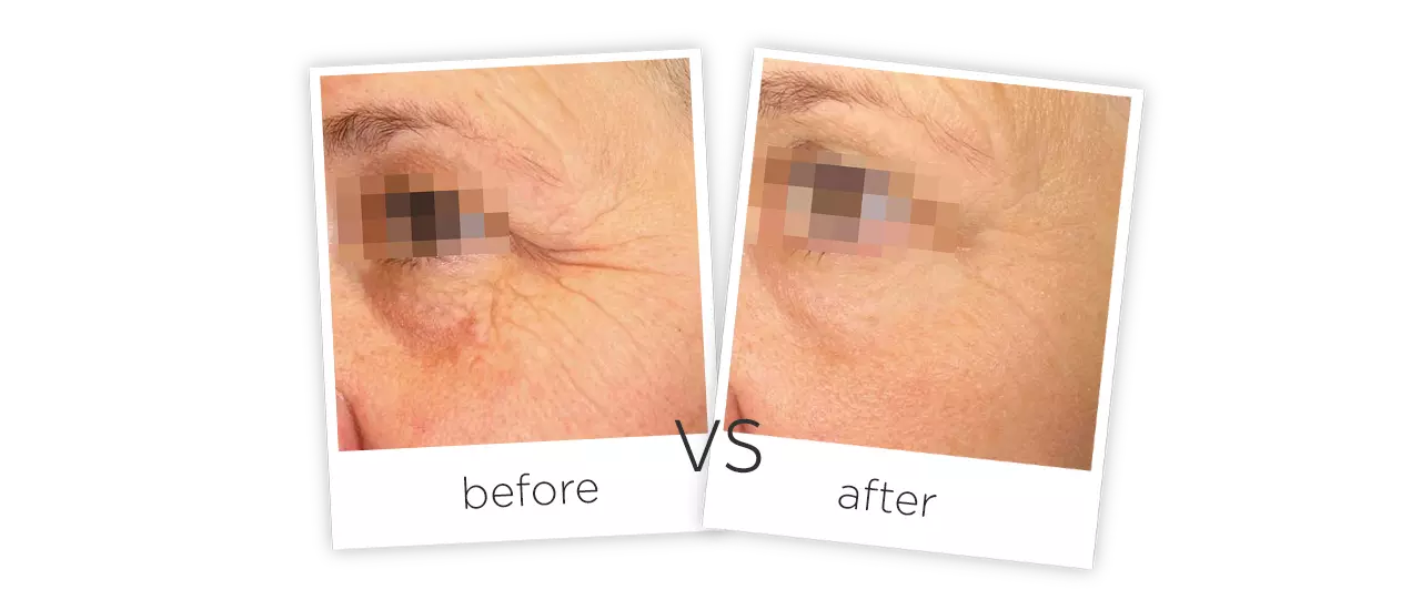 HIFU Treatment Before&After