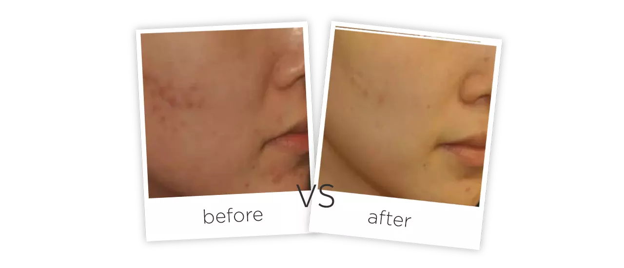PDT Led Light Therapy Machine Before&After