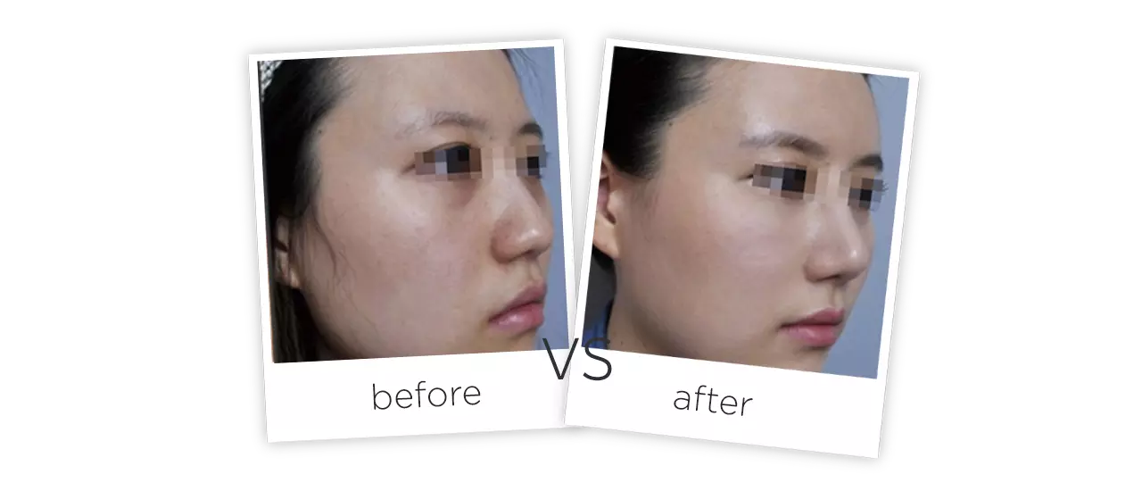 PDT Led Light Therapy Machine Treatment Before&After