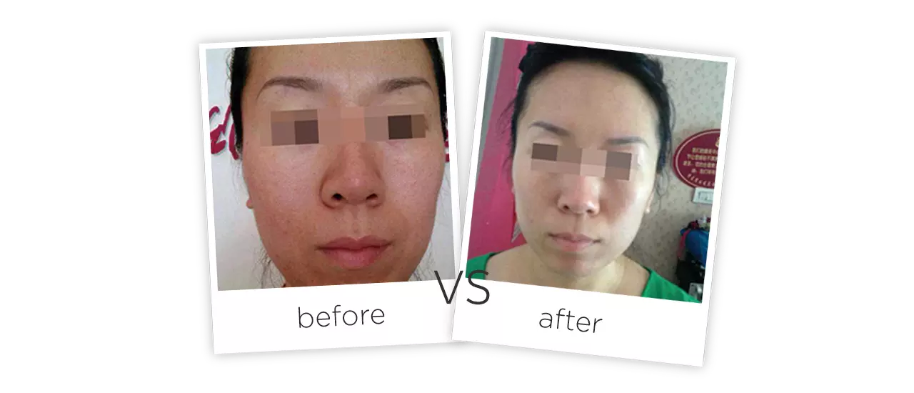 PDT Led Light Therapy Machine Treatment Before&After