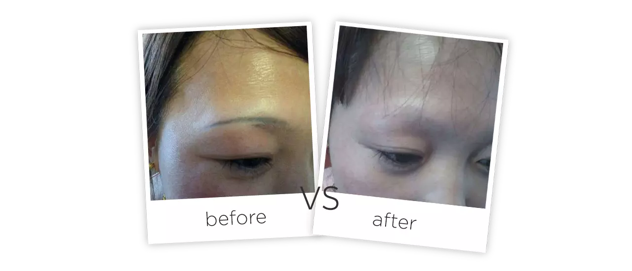 Q-switch Tattoo Removal Laser Before&After