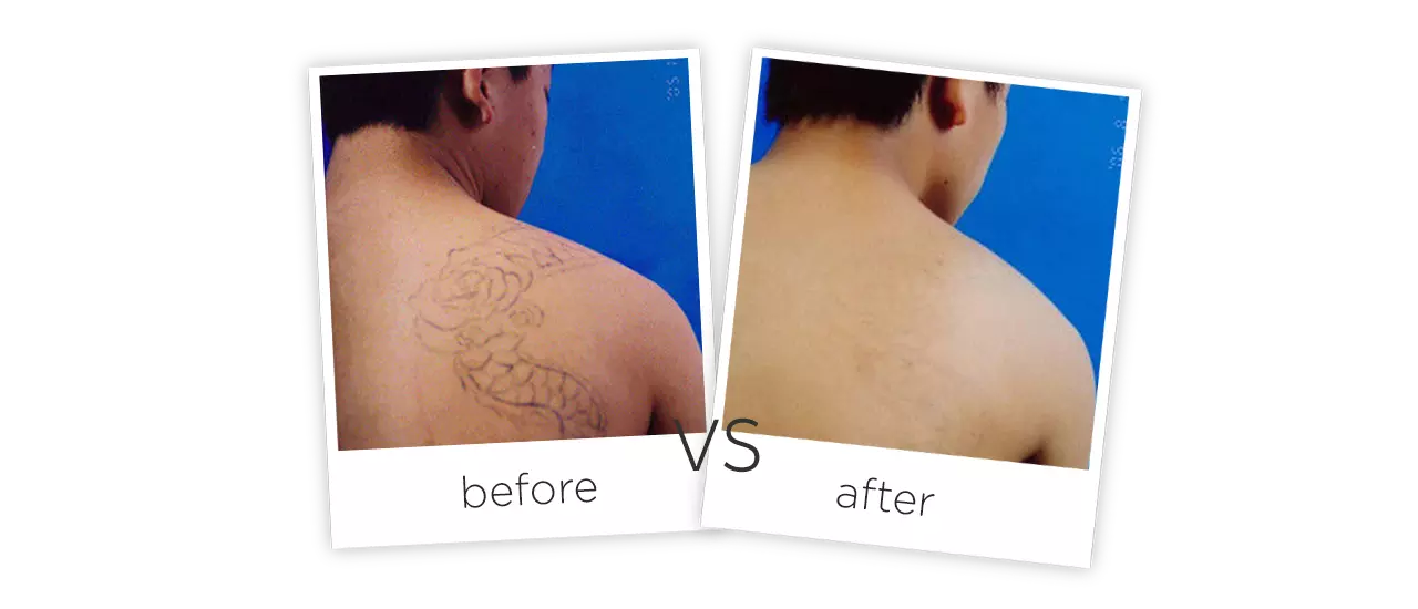 Q-switch Tattoo Removal Laser Treatment Before&After