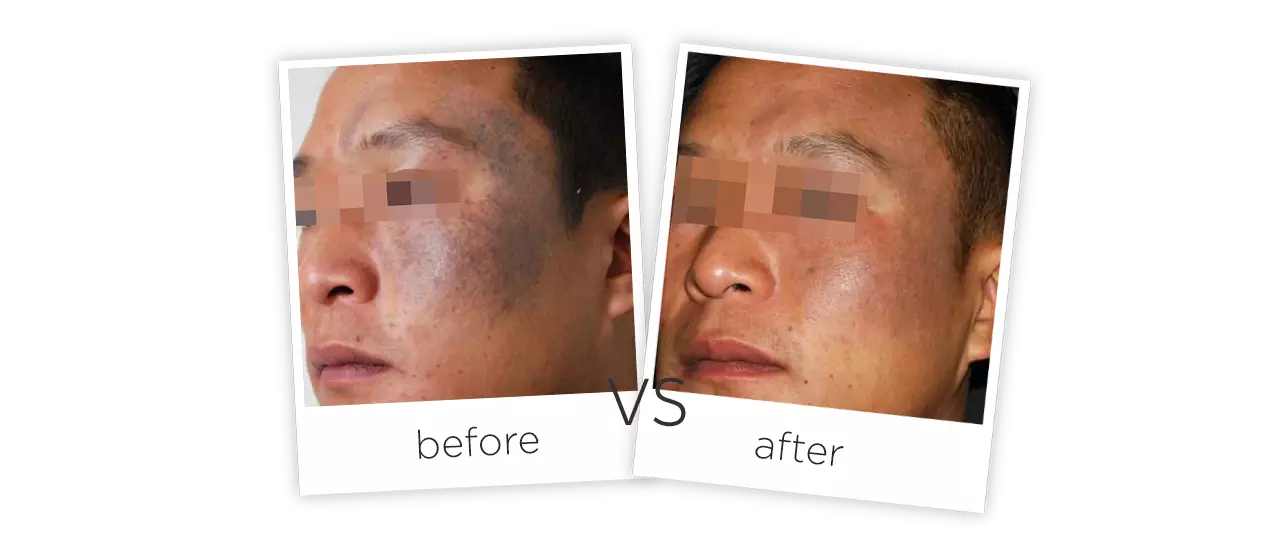 Q-switch Tattoo Removal Laser Treatment Before&After