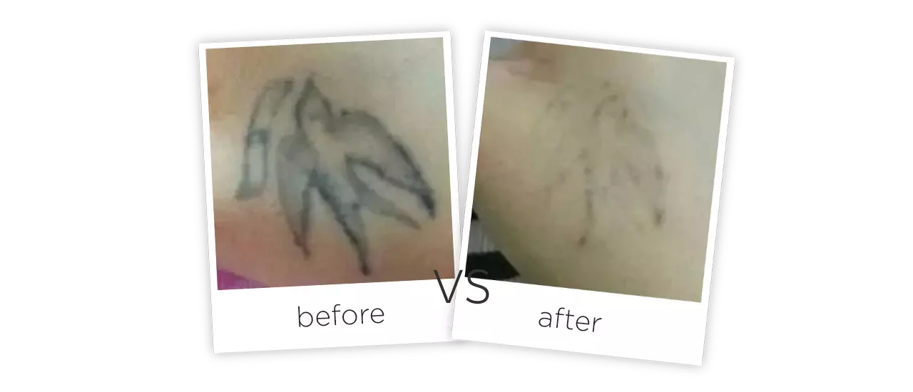 Q-switch Tattoo Removal Laser Treatment Before&After