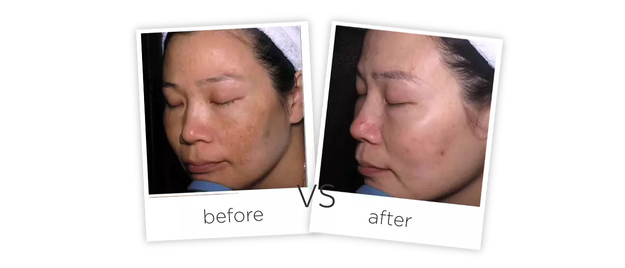 Q-switch Tattoo Removal Laser Treatment Before&After
