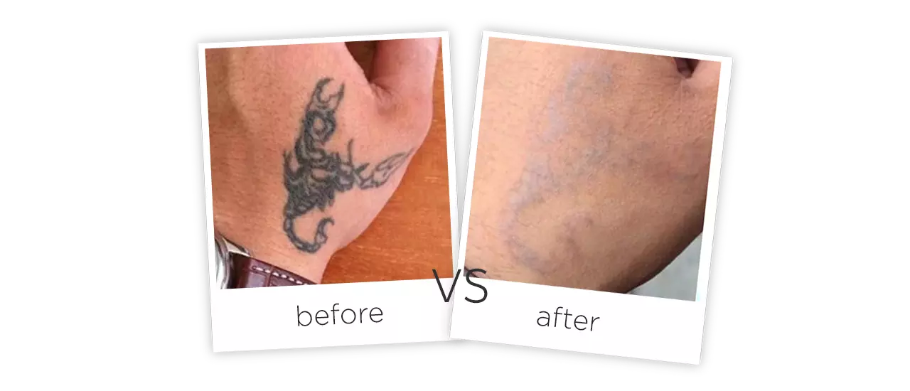 Q-switch Tattoo Removal Laser Treatment Before&After